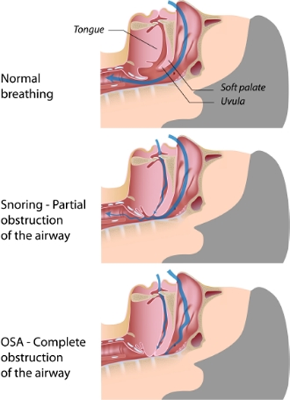 sleep apnea diagram