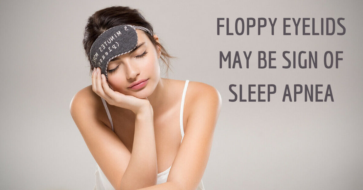 Floppy eyelids may be sign of sleep apnea